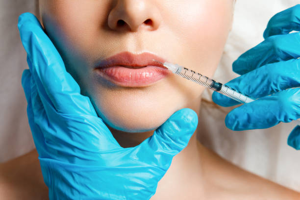 Client receiving half syringe lip filler for Valentine's Day natural lip enhancement at MiraMed and Day Spa in Santa Barbara