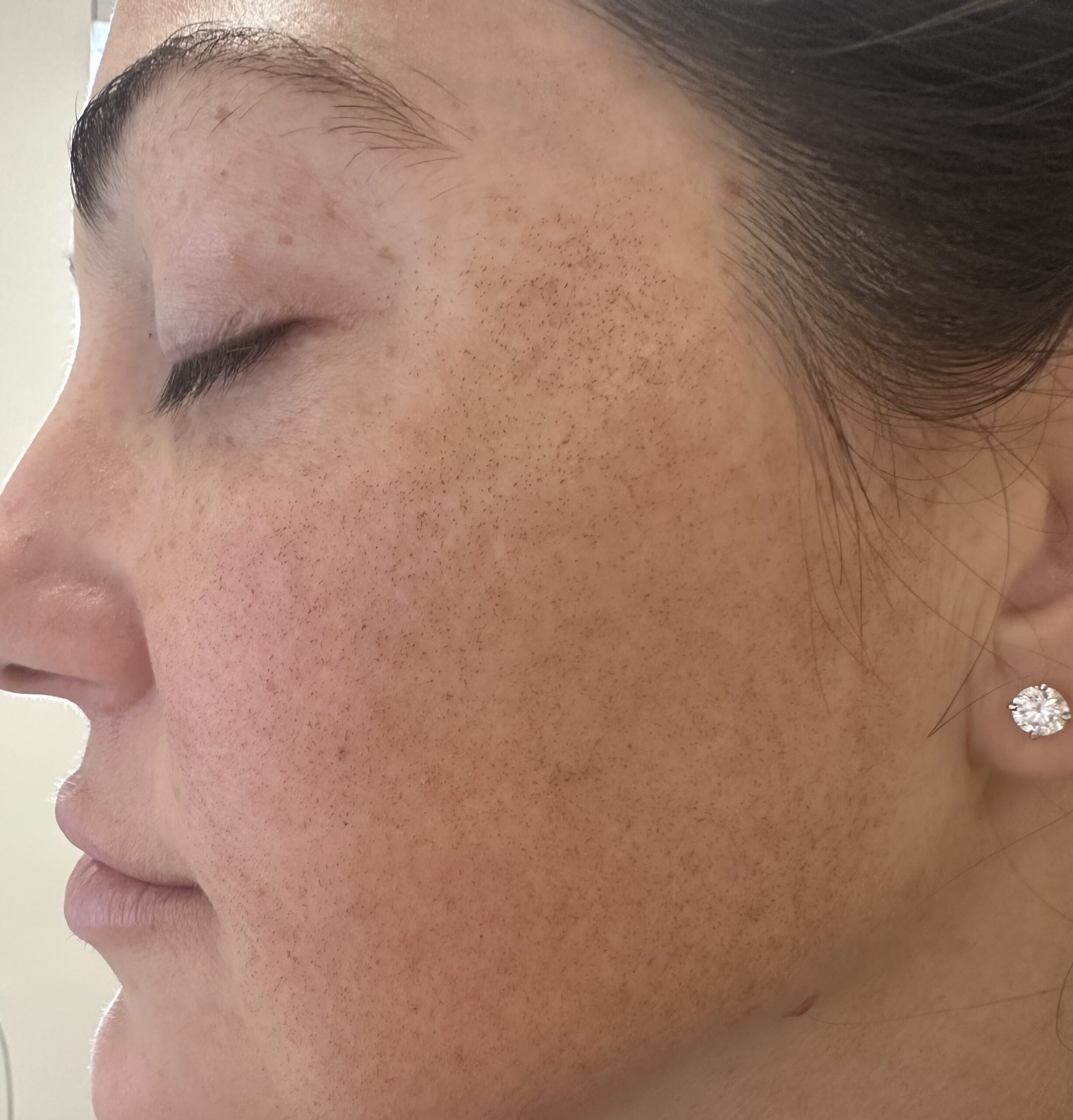 Woman with healthy, glowing skin and faint MENDs on cheek after Ultra laser treatment, spa setting, natural light.